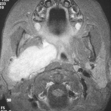 MRI of right masticator space rhabdomyosarcoma. Im