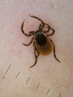 tick removal