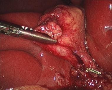 Laparoscopic cholecystectomy. Critical view, with 
