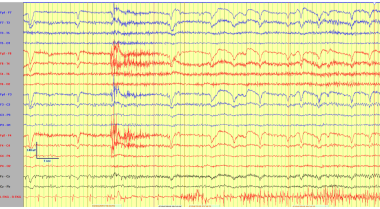 Electroencephalogram demonstrating a left fronto-c