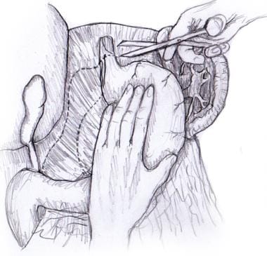 Hiatal repair. Sutures should be placed from poste
