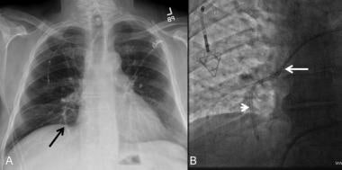 PA chest radiograph shows right subclavian port wi