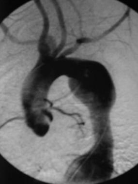 Aortogram of a 15-year-old adolescent girl with Ta