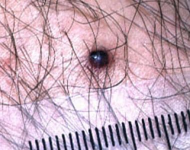 vulvar hemangioma