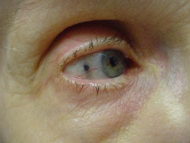 Drug-Induced Pigmentation Clinical Presentation: History 