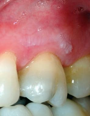 frictional keratosis gums