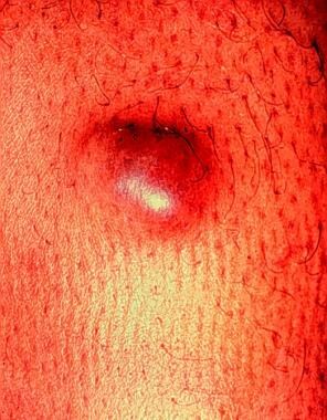 Erythematous nodule with macular component at the 