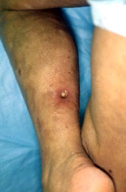 Ulceration of a lesion of calcinosis cutis in a pa