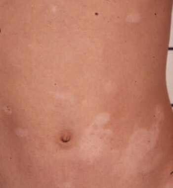 Vitiligo spots in a patient with Nijmegen breakage