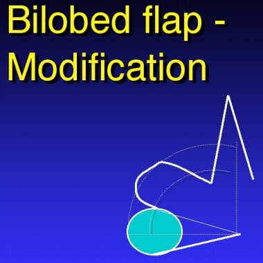 Bilobed flap modification. 
