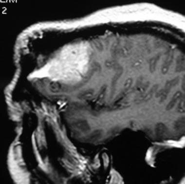 病例2:颅内脑膜瘤的钆增强MRI检查
