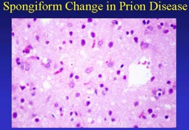 Prion-related diseases. Spongiform change in prion