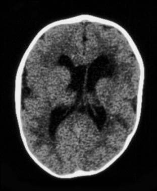 CT image demonstrating features of secondary crani