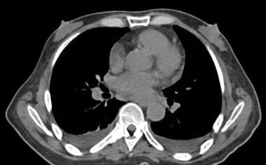 The Radiology Assistant : Pathology of the Male Breast