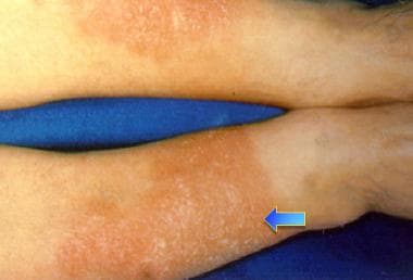 Bilateral erythematous infiltrative plaques on low