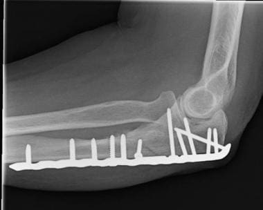 Plate fixation of distal olecranon fracture. 