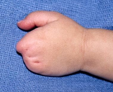 Dorsal view of left hand of 1.5-year-old patient w