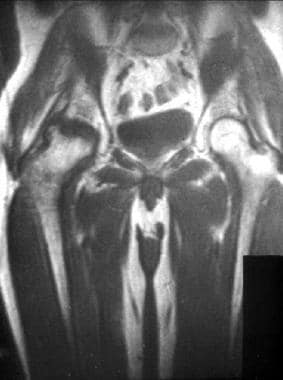MRI showing osteonecrosis of right hip, normal lef