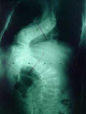 Early progressive type of scoliosis in a patient w