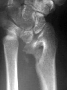 Postoperative anteroposterior radiograph of wrist 