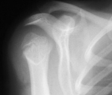 Anteroposterior radiograph of 7-year-old girl with
