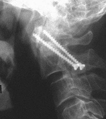 Lateral radiograph demonstrating fixation of a red