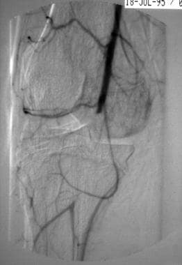 Angiographic evidence of vascular injury after tra