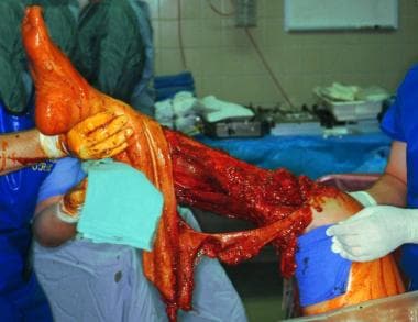 This photograph shows a leg that cannot be salvage