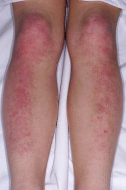 myositis skin rash