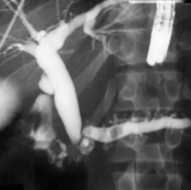 This endoscopic retrograde cholangiopancreatograph