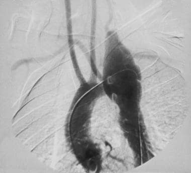 Angiogram demonstrating dissection of the aorta in