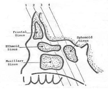 CT cuts for a limited CT study.