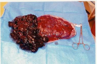 Placental abruption seen after delivery. 