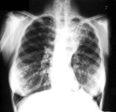 Cystic and cylindrical bronchiectasis of the right