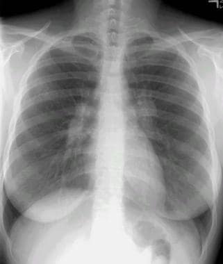 sarcoidosis life expectancy in the lung