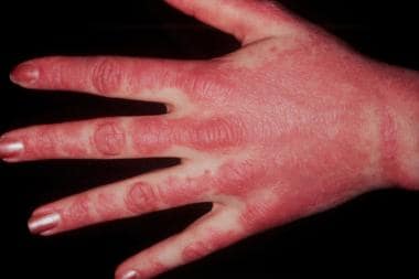 myositis skin rash