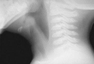 Soft-tissue lateral neck radiograph reveals edema 