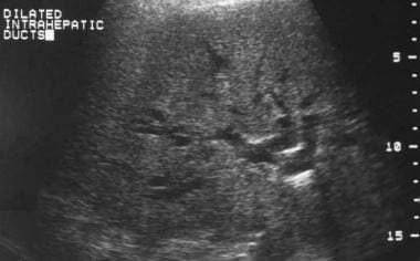 Sonogram of dilated intrahepatic ducts. 