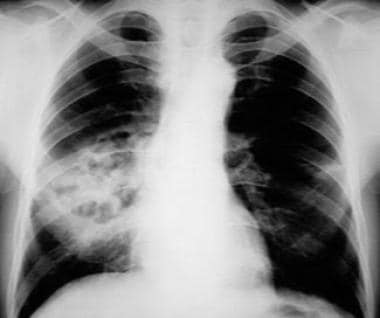 Pneumococcal pneumonia complicated by lung necrosi