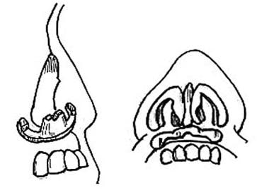 Premaxillary augmentation rhinoplasty. Example of 