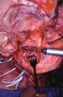 A temporal craniotomy and osteotomy for condylecto