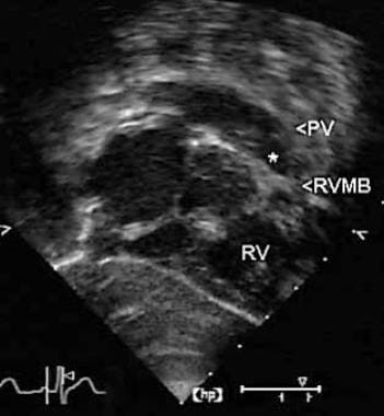 Subcostal right anterior oblique (RAO) echocardiog