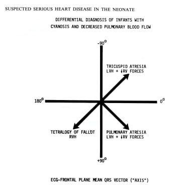 心电图平均QRS向量(轴)的使用