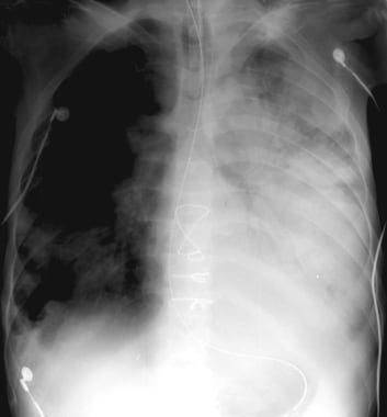Extensive left-lung pneumonia caused respiratory f