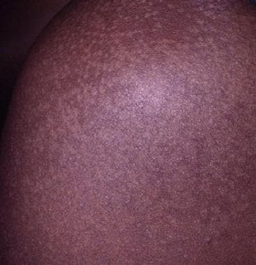 In some patients, the areas affected by tinea vers