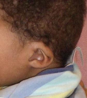 Typical ear malformation 