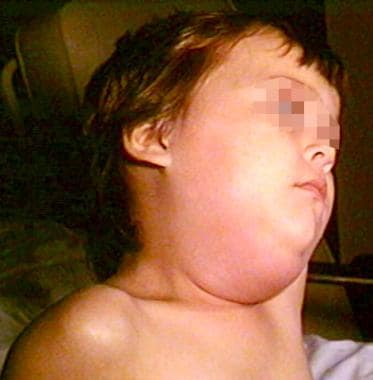 Child with mumps. 