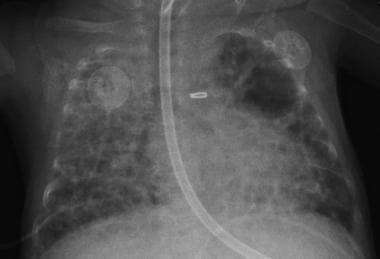 Chest radiograph of infant with bronchopulmonary d