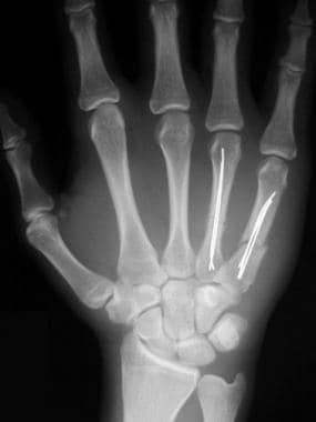 Fourth and fifth metacarpal fractures after intram