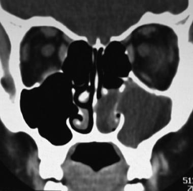 Coronal CT scan through the anterior sinuses showi
